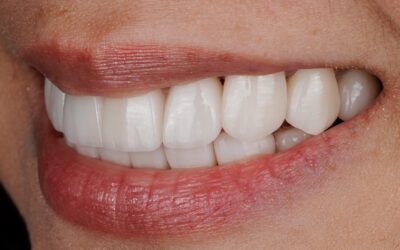 Composite vs. Porcelain Veneers: Which is Right for You?